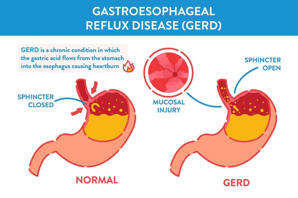 acid reflux